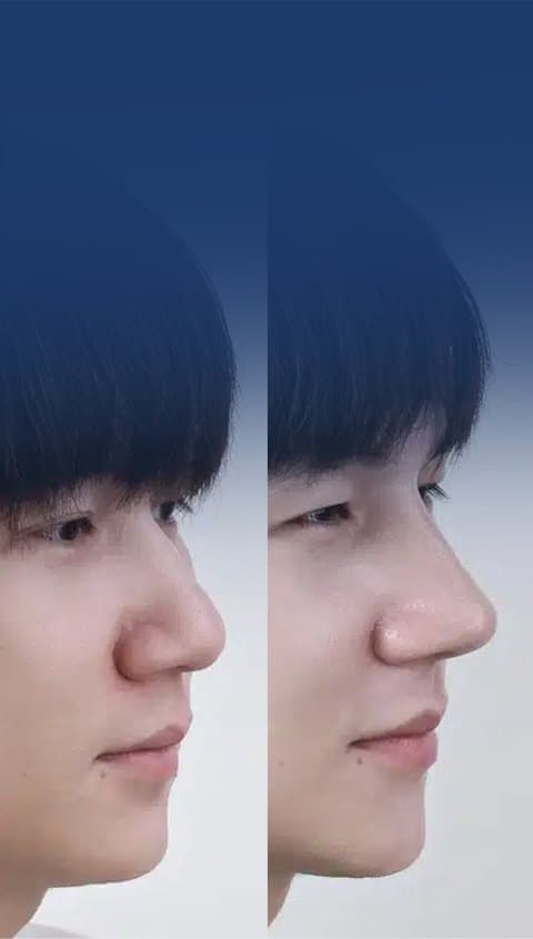รีวิวการเสริมจมูก