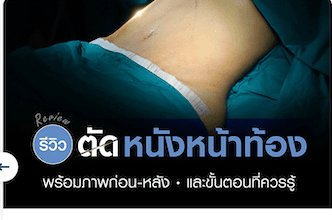 รีวิวตัดหนังหน้าท้อง พร้อมภาพก่อน–หลัง และขั้นตอนที่ควรรู้