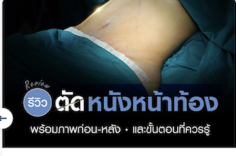 รีวิวตัดหนังหน้าท้อง พร้อมภาพก่อน–หลัง และขั้นตอนที่ควรรู้